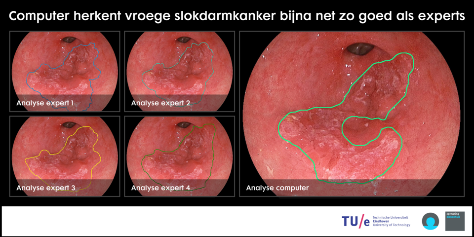 TU/e-software helpt opsporing slokdarmkanker fors vooruit