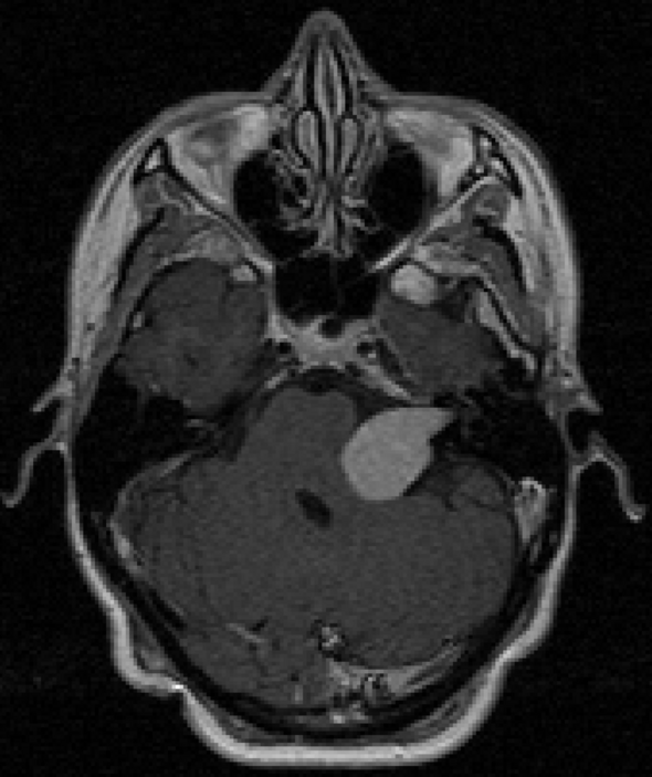 MRI-beeld met iets rechts van het midden een grote brughoektumor. Afbeelding | Elisabeth-TweeSteden Ziekenhuis